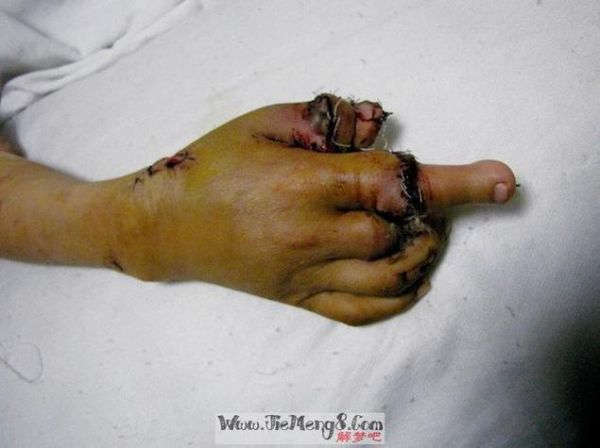 梦到断手是什么意思_断手梦境预示什么