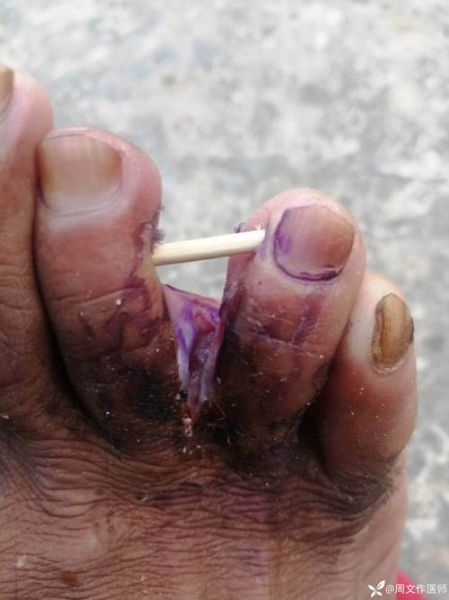 梦到脚腐烂是什么意思_梦见脚腐烂预示什么