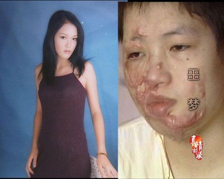 梦到自己被毁容是什么意思_如何缓解噩梦带来的焦虑