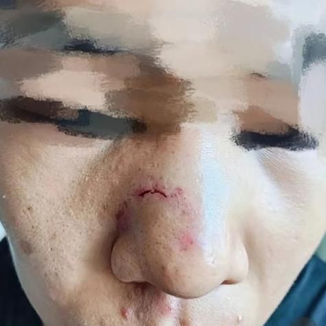 女人鼻子疤痕影响财运吗_如何化解