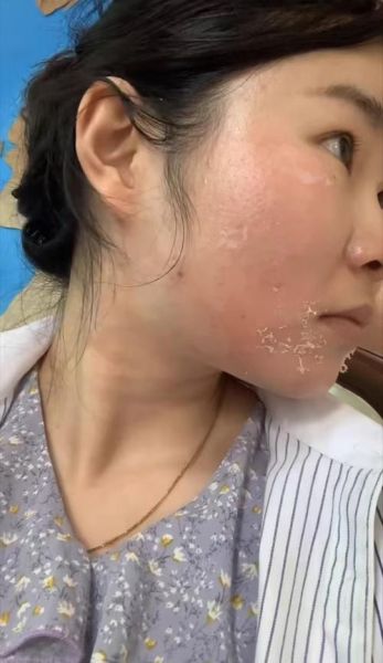 梦到脸上长癣是什么意思_脸上长癣梦境解析