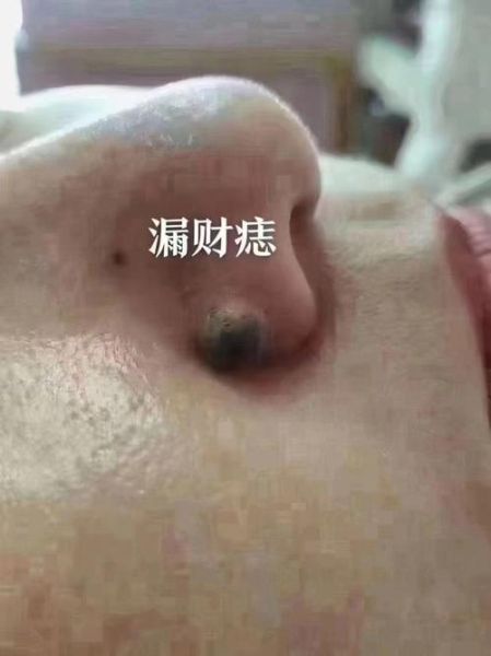 天生的财运痣在哪_财运痣怎么看