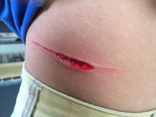 梦到结疤是什么意思_梦到结疤预示什么